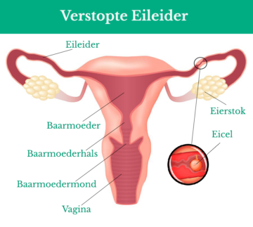 Schematische weergave van een baarmoeder met een verstopte eileider bij verminderde vruchtbaarheid vrouw