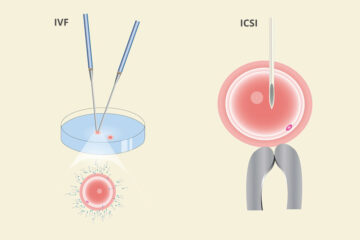 Schematische weergave van het verschil tussenI CSI en IVF bevruchting