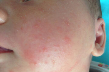 Een wangetje van een baby met baby acne