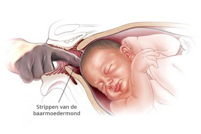 Strippen van de baarmoedermond om de bevalling op te wekken