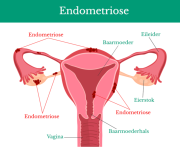 Endometriose En Zwanger Worden 24baby Nl