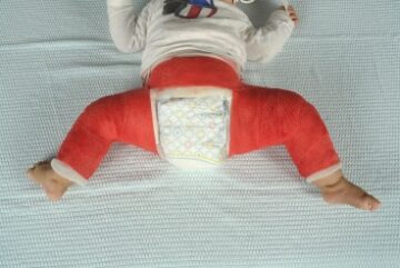 Baby die een gipsbroek draagt in verband met heupdysplasie
