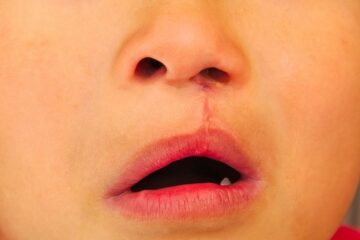 Kindje met behandelde schisis, hazenlip