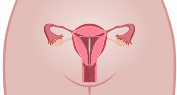 Baarmoeder met IUD bij Asherman syndroom