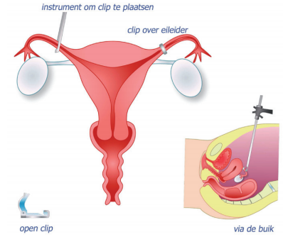 schematische weergave van sterilisatie bij de vrouw