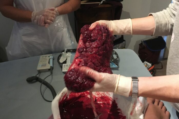 De placenta buiten de baarmoeder