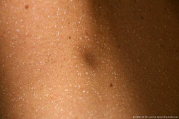 Huid met miliaria crystallina, een vorm van warmte uitslag