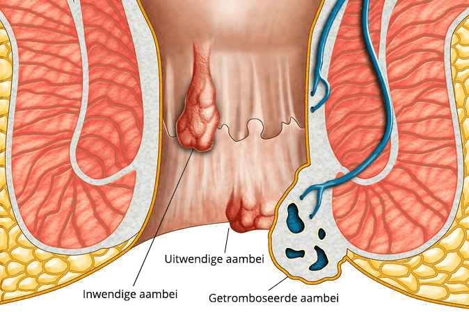 Schematische weergave van inwendige, uitwendige en getromboseerde aambei na de bevalling