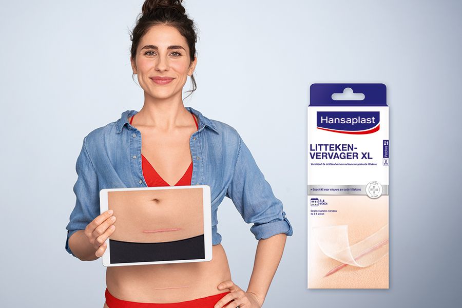 Vrouw laat een foto zien van haar keizersnede