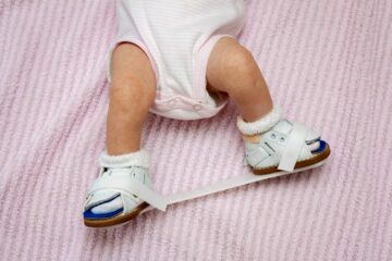 Baby draagt brace of speciale schoen voor behandeling van klompvoet