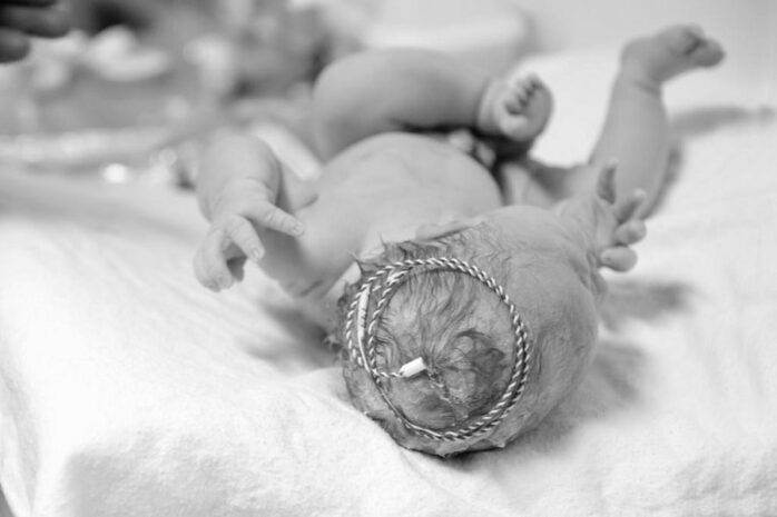Pasbevallen baby met CTG-draadje nog op zijn hoofd