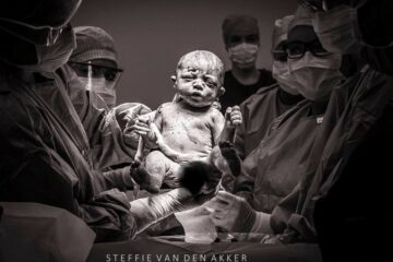 Baby wordt geboren met keizersnede en alle artsen staan eromheen