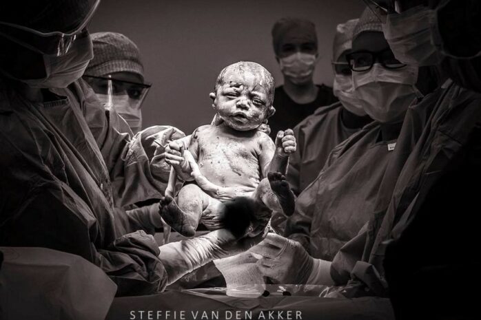 Baby wordt geboren met keizersnede en alle artsen staan eromheen