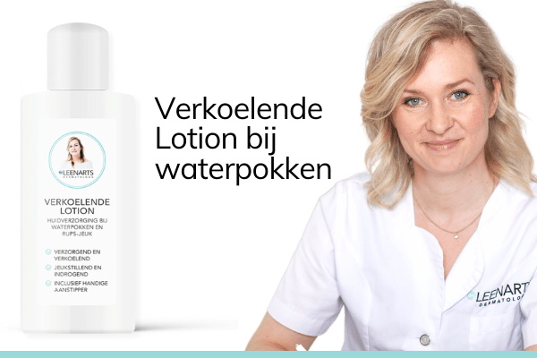 Verkoelende lotion bij waterpokken