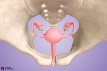 3D model pcos