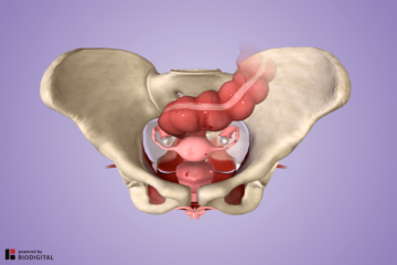 3D model van endometriose
