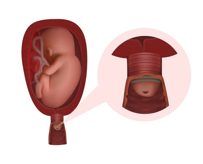 Cerclage
