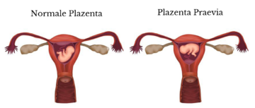 Abbildung einer normalen und einer Placenta praevia