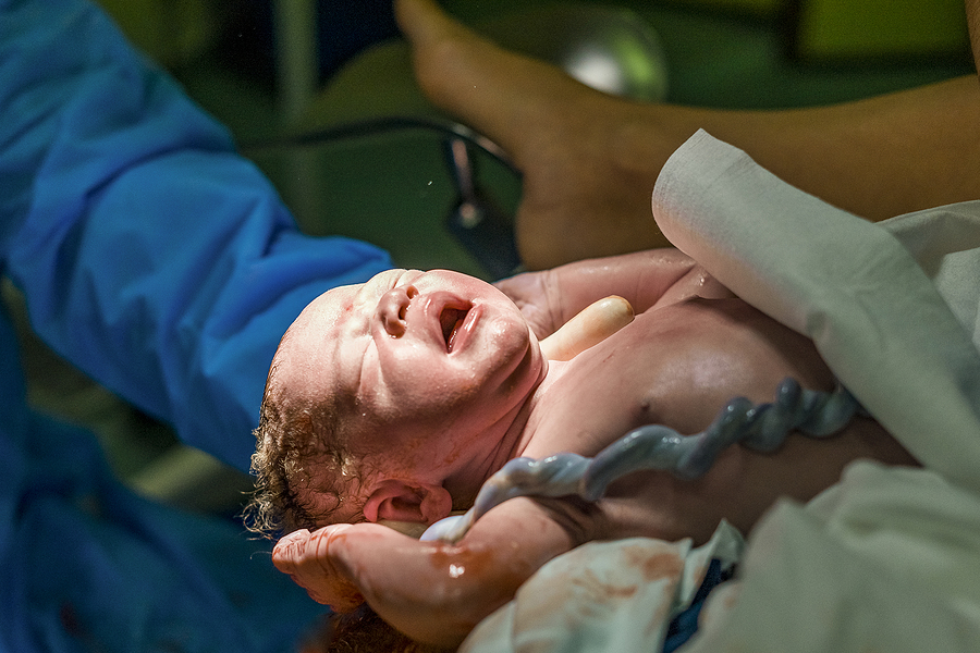 Ein neugeborenes Baby kommt zur Welt mit der Nabelschnur über der Schulter.