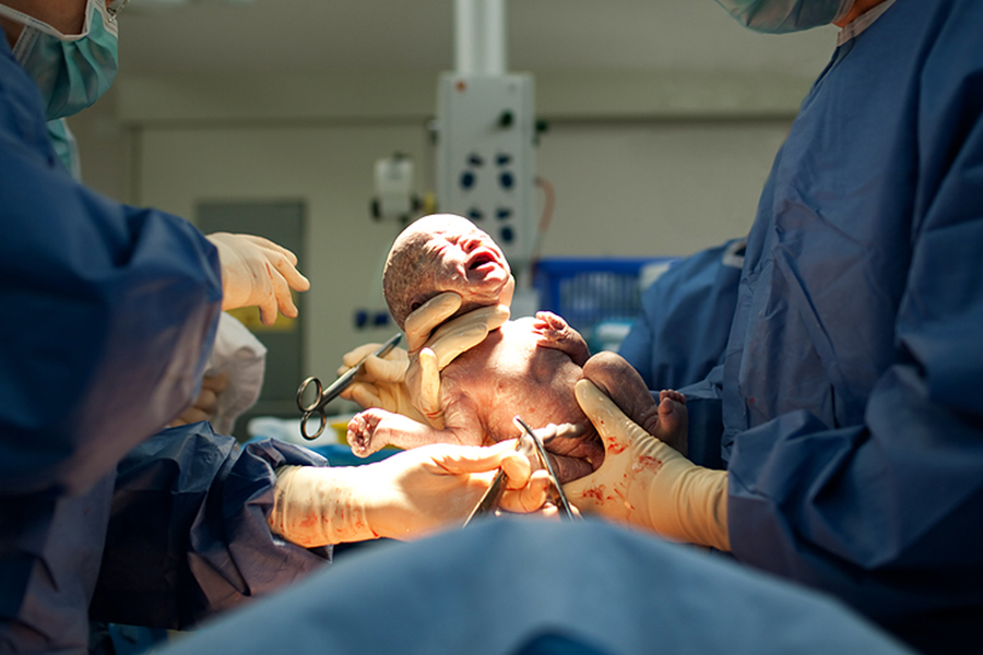 Ein Baby kommt per Kaiserschnitt zur Welt.