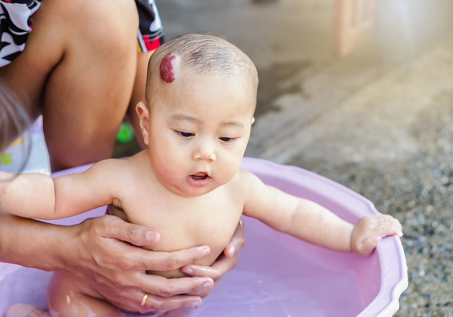 Süßes Baby mit Hämangiom am Kopf planscht.