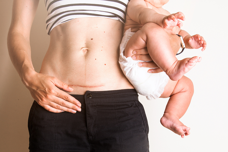 Kaiserschnittnarbe auf dem Bauch einer Mutter, die ihr Baby auf dem Arm trägt